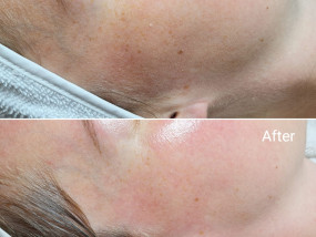 Dermaplaning dermaplaning gelaatsverzorging skincare huidverbetering