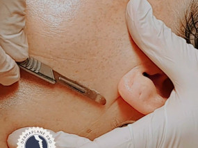 gelaatsverzorging skincare dermaplaning before and after skincare gelaatsverzorging