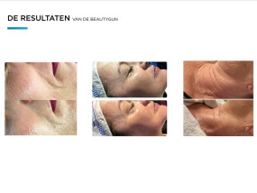 coolifting before and after verjonging skincare sothys gelaatsverzorging huidverbetering intensive youth treatment facial