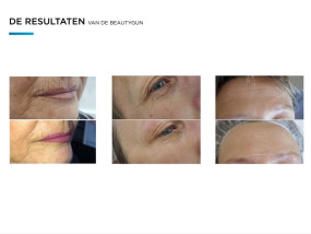 coolifting before and after verjonging skincare sothys gelaatsverzorging huidverbetering intensive youth treatment facial