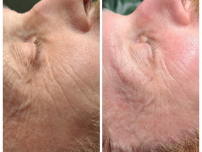 Before & After verjonging skincare sothys gelaatsverzorging huidverbetering intensive youth treatment facial