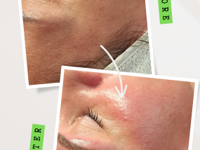 dermaplaning before and after skincare gelaatsverzorging