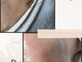 Dermaplaning before and after skincare huidverbetering gelaatsverzorging 