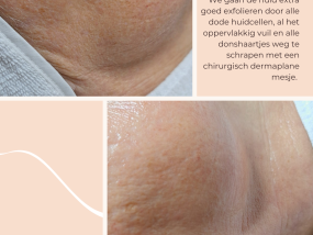 Dermaplaning before and after skincare huidverbetering gelaatsverzorging