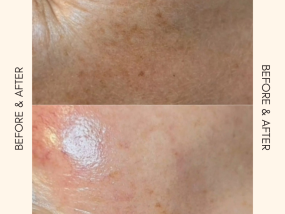 Dermaplaning skincare huidverbetering before and after gelaatsverzorging