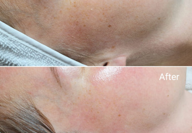 Dermaplaning before and after skincare huidverbetering gelaatsverzorging 