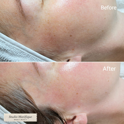 Dermaplaning before and after skincare huidverbetering gelaatsverzorging 